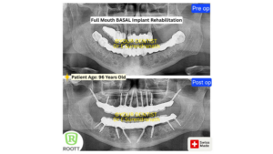 Before and after X ray of full mouth basal implant rehabilitation in 96 year old patient showing fixed teeth results in Vijayawada