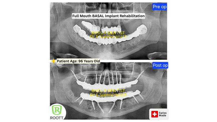 Before and after X ray of full mouth basal implant rehabilitation in 96 year old patient showing fixed teeth results in Vijayawada