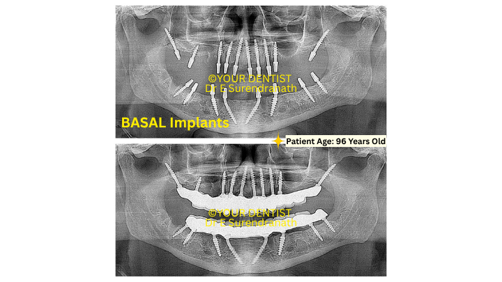X ray images showing multiple basal implants placed for full mouth rehabilitation in 96 year old patient Vijayawada