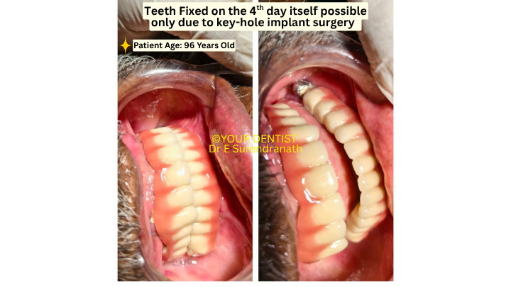 Fixed teeth in just 3 days using keyhole implant surgery showing immediate loading results in 96 year old patient Vijayawada