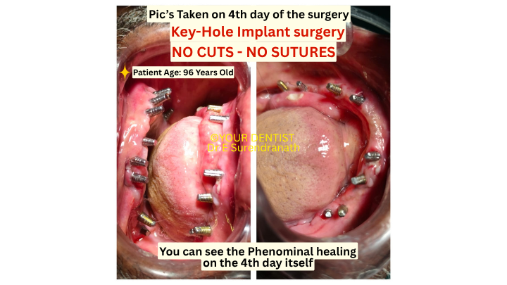 Keyhole dental implant surgery showing no cuts no sutures and healing on day 3 in 96 year old patient Vijayawada